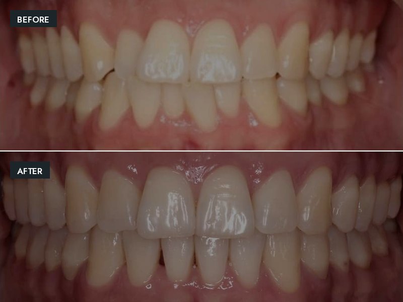 Before and after: upper and lower arches aligned with Invisalign clear aligners