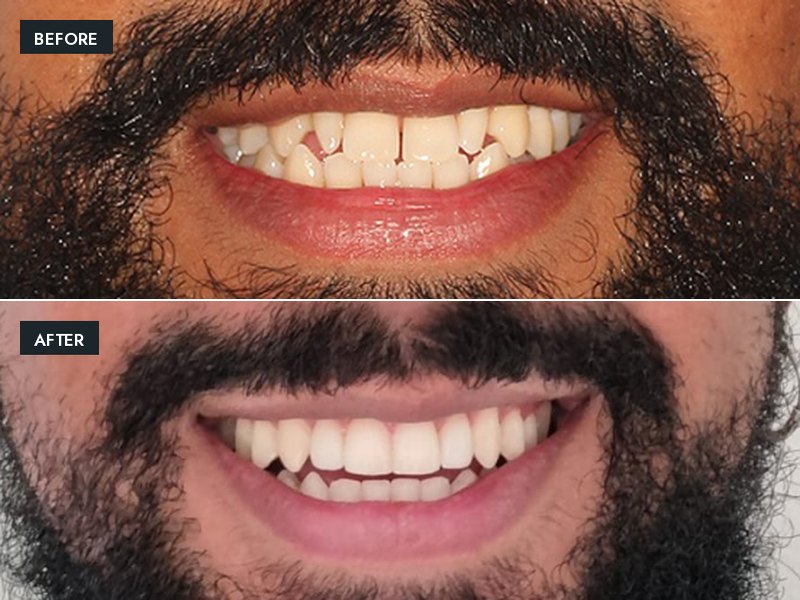 Before and after: spacing and chipped edges corrected with orthodontics and porcelain veneers
