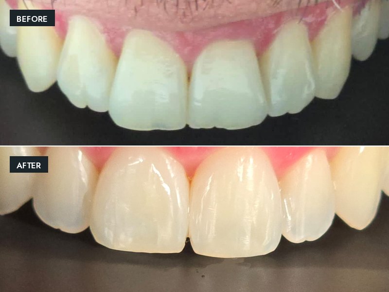 Before and after close-up: worn upper incisors restored with minimally invasive smile design