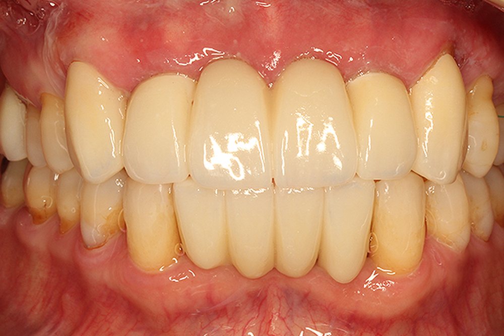 The same mouth restored with dental implants and crowns at Medellin Dental Solutions in Medellín