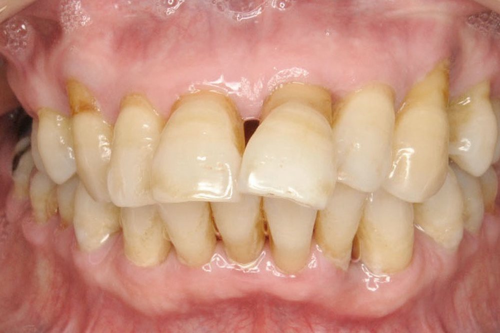 Worn and uneven teeth with gaps, before implant treatment at Medellin Dental Solutions in Medellín
