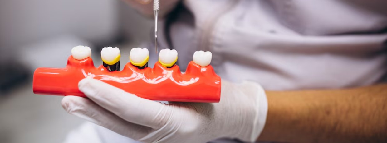 Dental implant model showing titanium posts with abutments and crowns