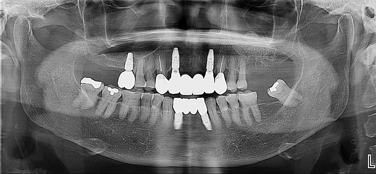 Panoramic X-ray showing five dental implants placed in the jaw at Medellin Dental Solutions in Medellín