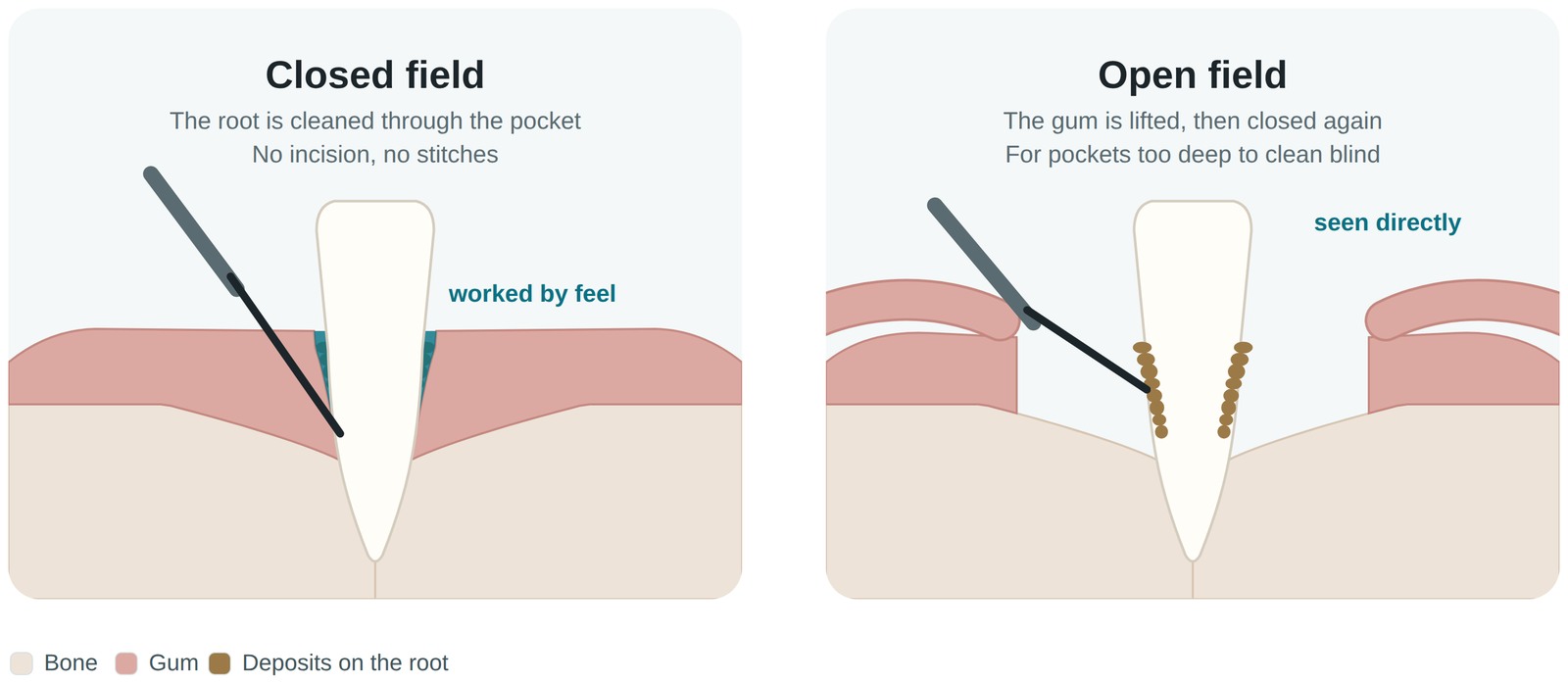 Closed field and open field scaling and root planing, the two forms of gum disease treatment in Medellín