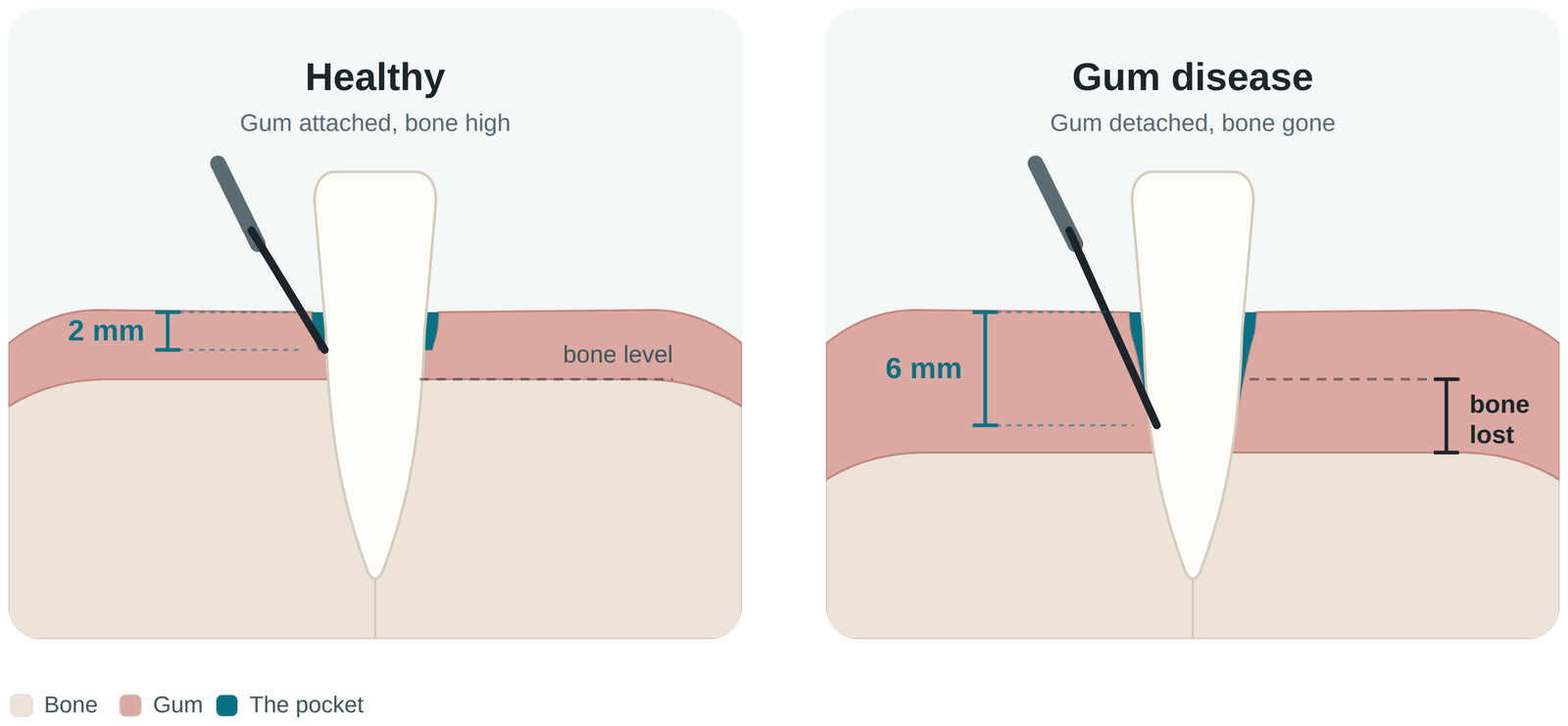 What gum disease treatment is measuring: a healthy 2 mm sulcus beside a 6 mm periodontal pocket with bone loss
