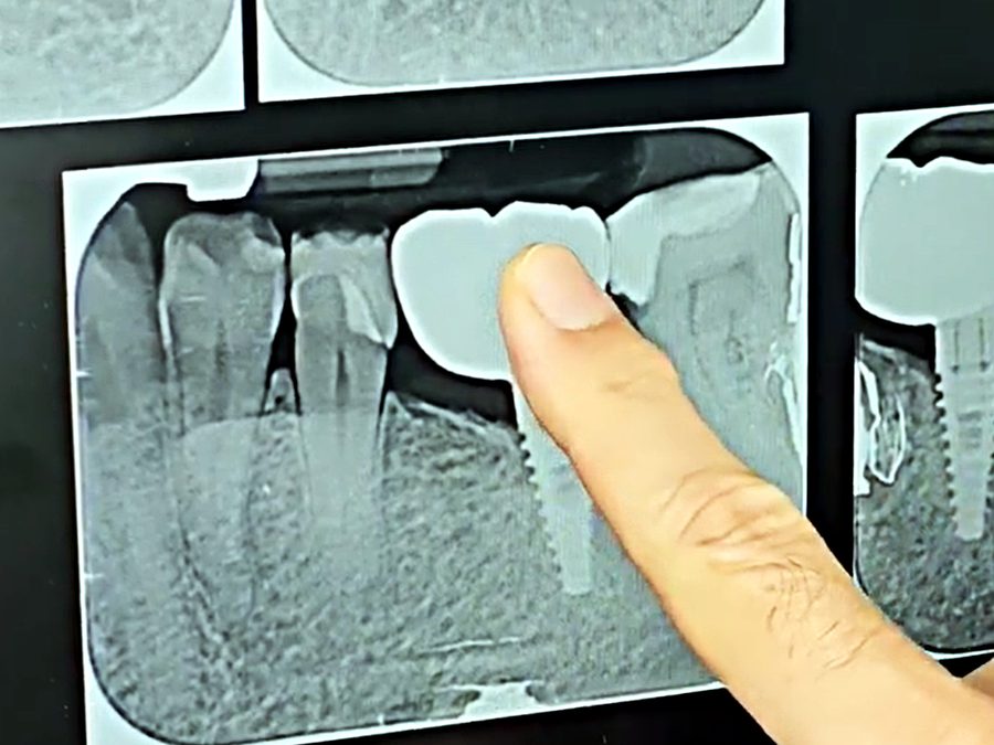 X-ray of a dental implant in bone with its crown, at Medellin Dental Solutions in Medellín