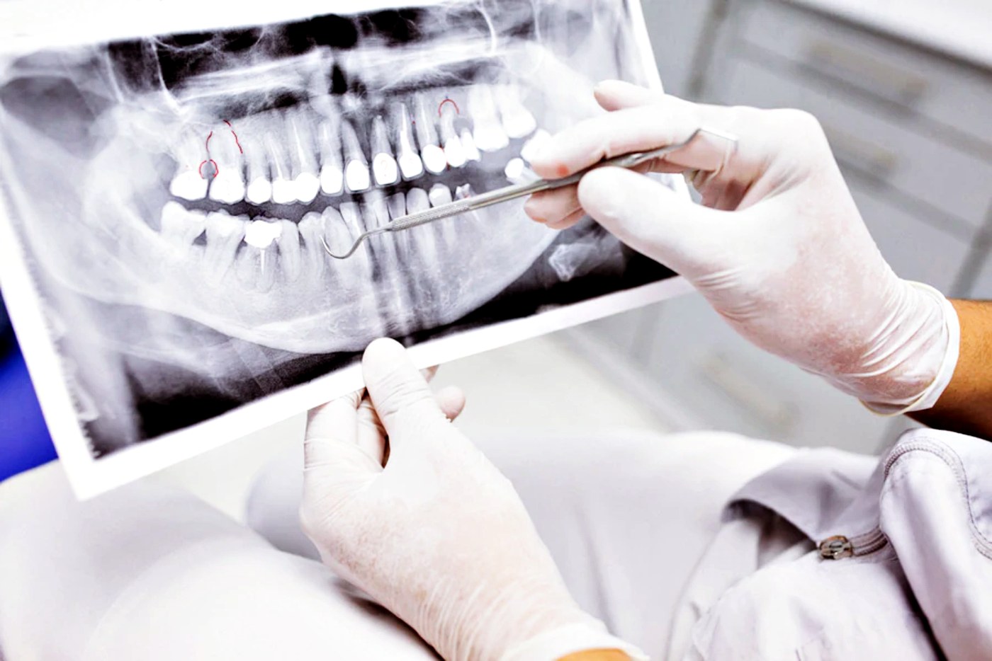 A panoramic X-ray being read before wisdom teeth removal in Medellín at Medellin Dental Solutions
