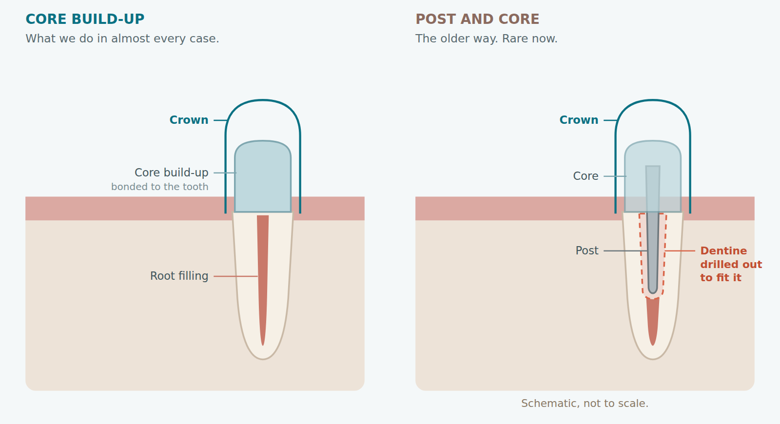 Diagram comparing a core build-up and a post and core in a root-treated tooth, at Medellin Dental Solutions in Medellín