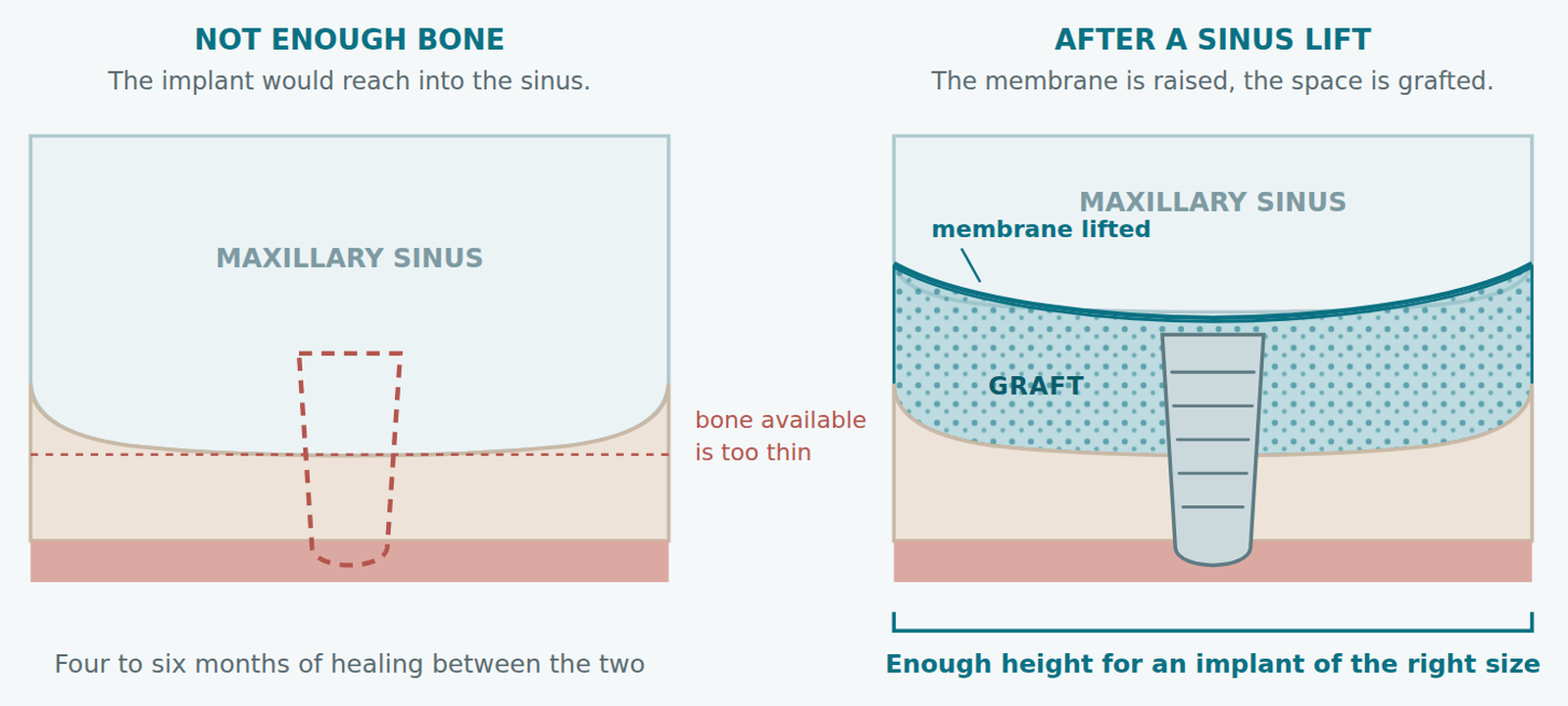 Diagram of a sinus lift before and after: thin bone under the maxillary sinus, then the membrane raised and the space grafted so a dental implant fits
