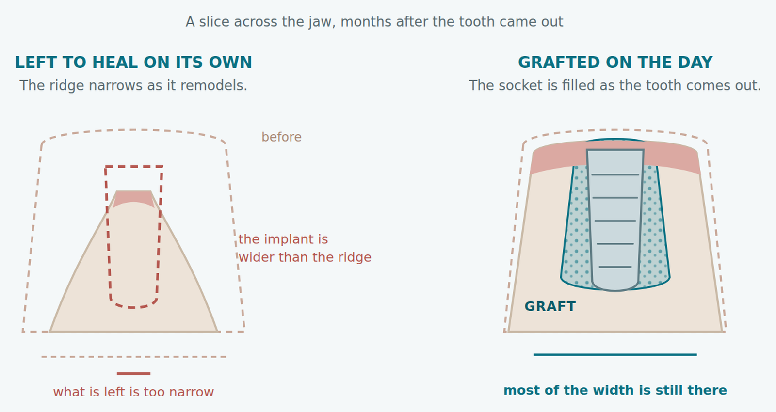 Diagram of socket preservation: a jaw ridge left to heal alone becomes too narrow for an implant, while a grafted socket keeps most of its width