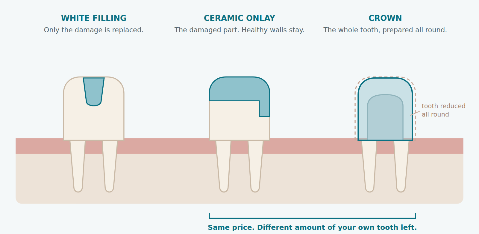 Diagram comparing white dental fillings, a ceramic onlay and a crown, and how much of the tooth each one covers