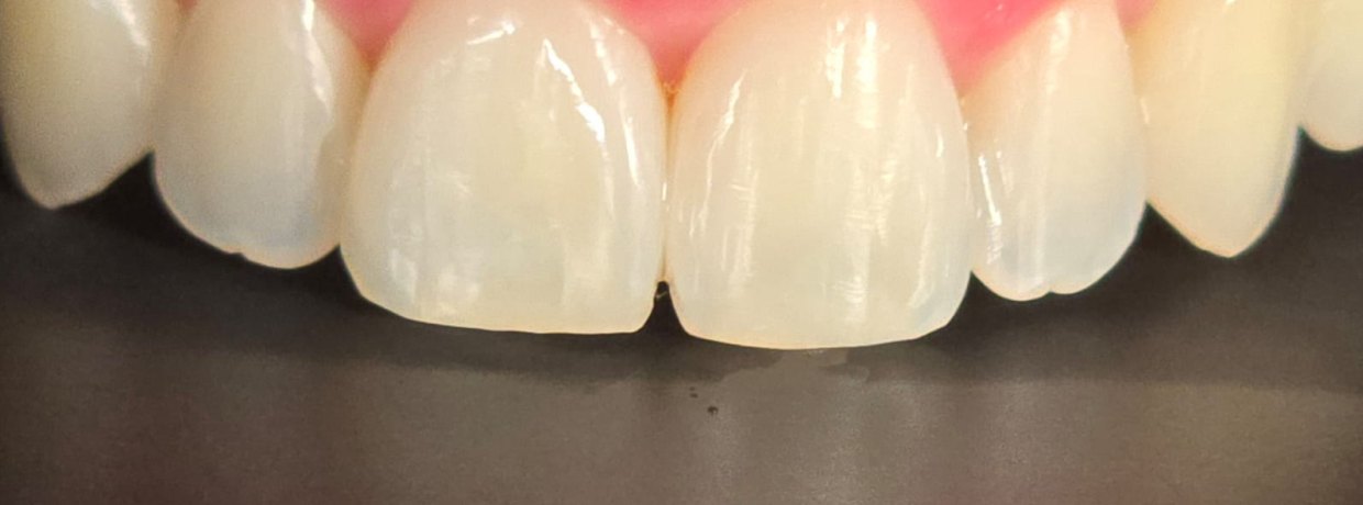 White dental fillings in Medellín at Medellin Dental Solutions