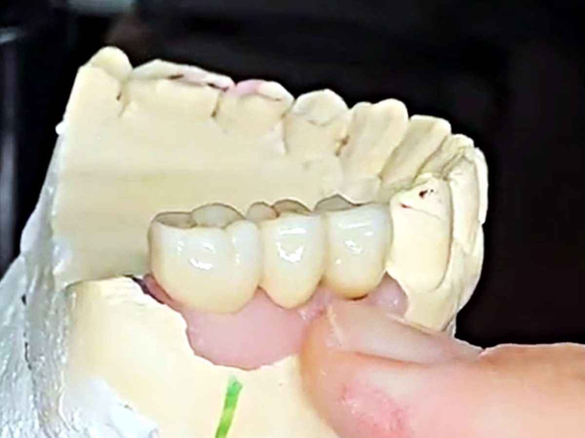 A three-unit zirconia bridge — two crowns joined to a replacement tooth — on a plaster model at Medellin Dental Solutions in Medellín