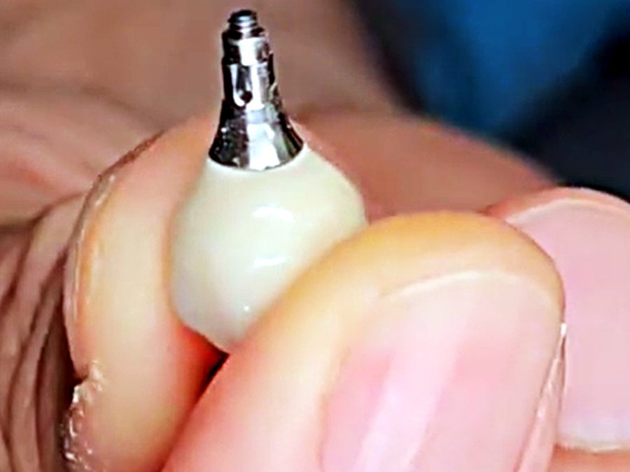 Zirconia crown on a titanium abutment for a dental implant in Medellín at Medellin Dental Solutions